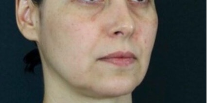 Înainte de tratament - pomeți căzuți